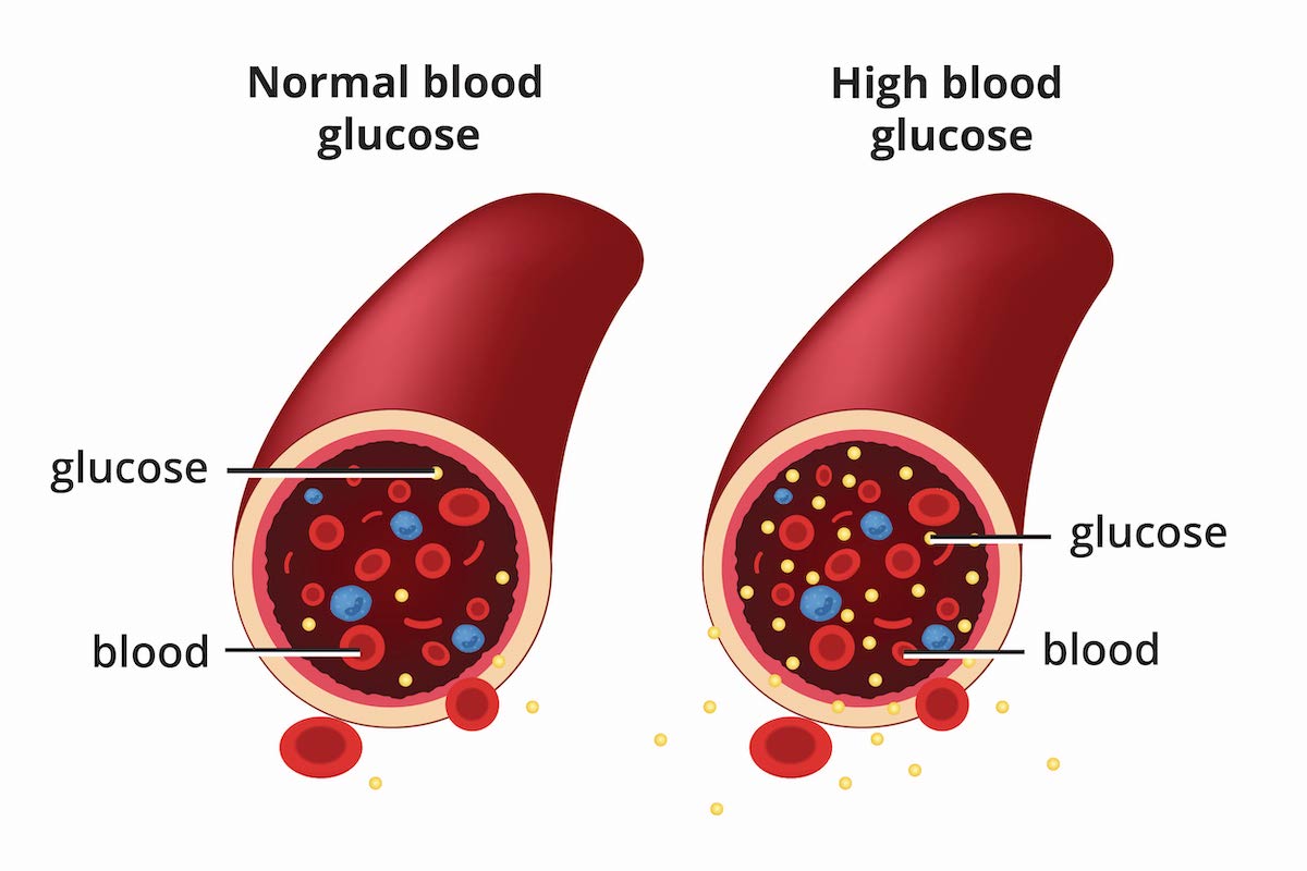 understanding-diabetes